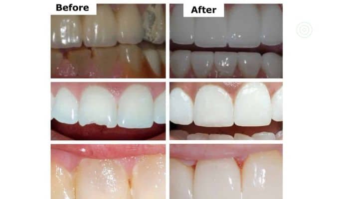 teeth crowns before-and after