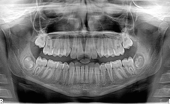 Bone Graft Wisdom Teeth