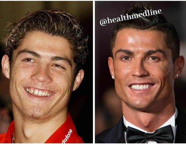 Ronaldo Teeth