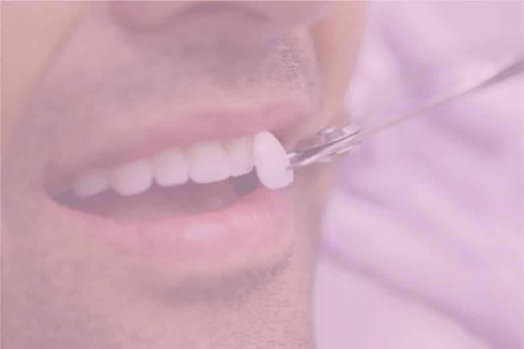 Shaved Teeth for Veneers