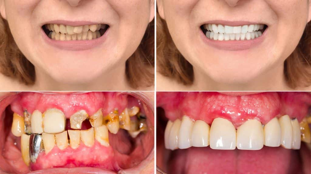 What Do Teeth Look Like under Veneers